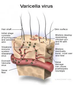 Varicella_virus